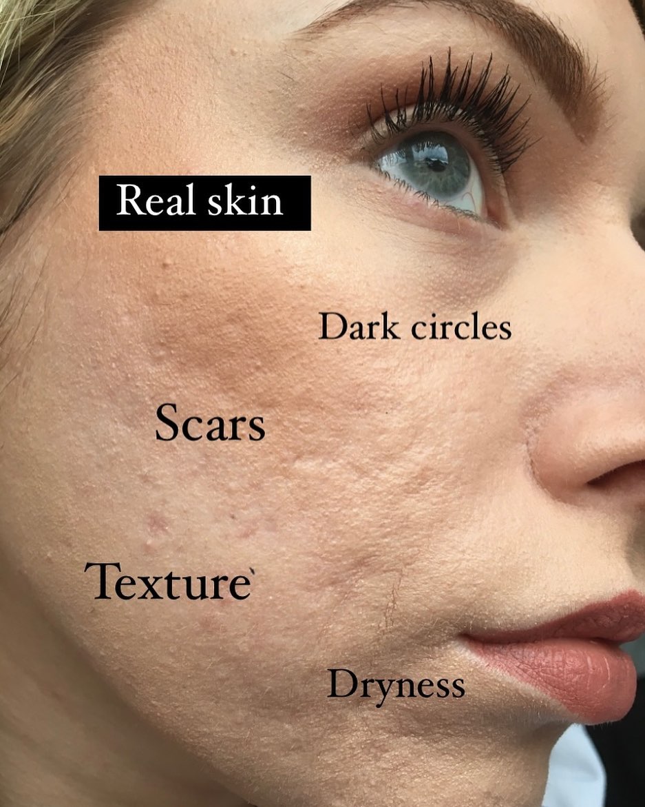 acne problem spaces