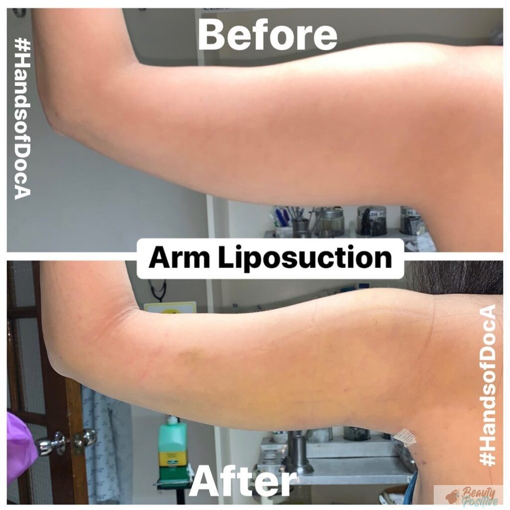 Comprehensive Guide to Liposuction Costs